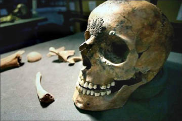 One of the skulls found at York shows cracks on the side which could have been caused by a blow from Charon's hammer.